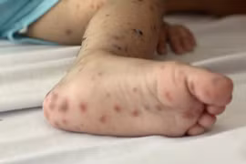 印尼手足口病例呈现上升趋势