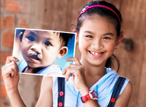 200名病儿将获免费唇部整形手术 ảnh 1 200名病儿将获免费唇部整形手术 ảnh 1