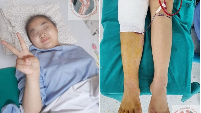 越南成功对年龄最小的患者进行股骨头的置换手术 ảnh 1 越南成功对年龄最小的患者进行股骨头的置换手术 ảnh 1