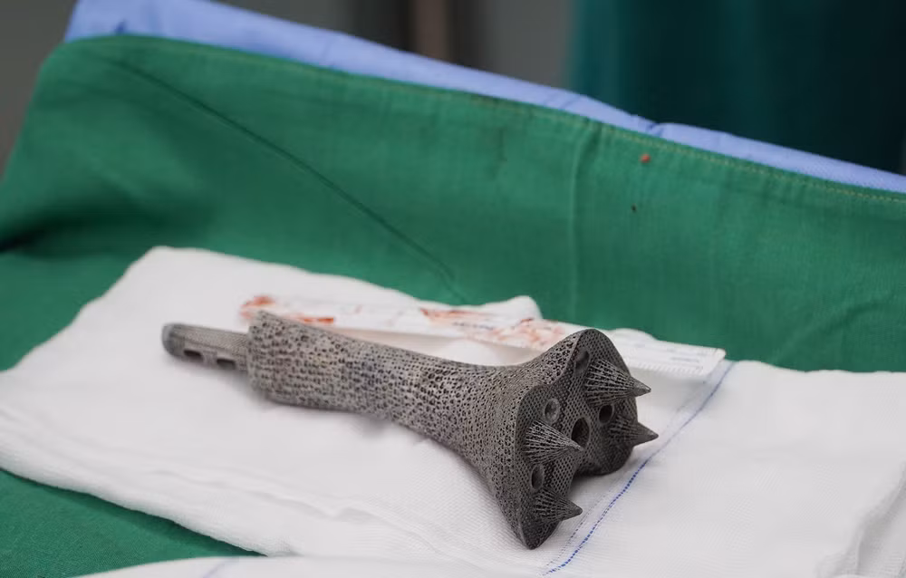 胡志明市大水镬医院成功为骨癌患者实施3D打印钛合金骨骼置换术 ảnh 2 胡志明市大水镬医院成功为骨癌患者实施3D打印钛合金骨骼置换术 ảnh 2