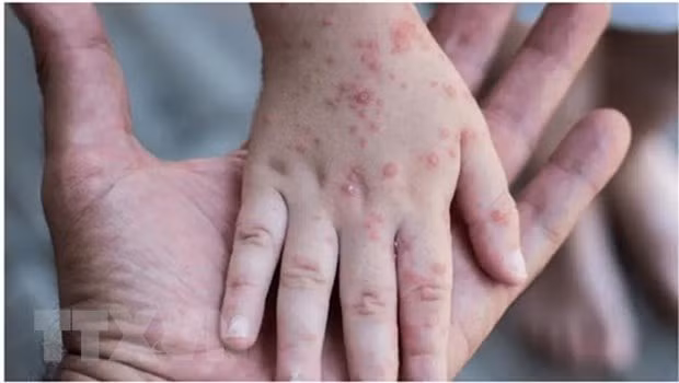 世卫组织驻越代理首席代表:提升猴痘病毒的监测和诊断能力 做好猴痘疫情防控应对工作 ảnh 2 世卫组织驻越代理首席代表:提升猴痘病毒的监测和诊断能力 做好猴痘疫情防控应对工作 ảnh 2